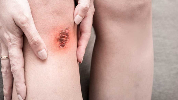 Cách làm vết thương hở mau khô - Giải pháp phục hồi nhanh, ngăn ngừa viêm nhiễm và sẹo xấu