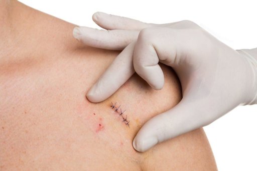 Những sai lầm trong chăm sóc sau phẫu thuật dễ gây nhiễm trùng