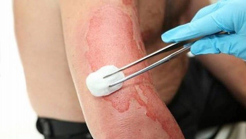 HEMA: Giải pháp phục hồi da do bỏng với cơ chế SHA Polymer