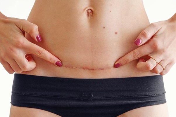 Chăm sóc vết thương sau hút mỡ bụng với HemaHeal