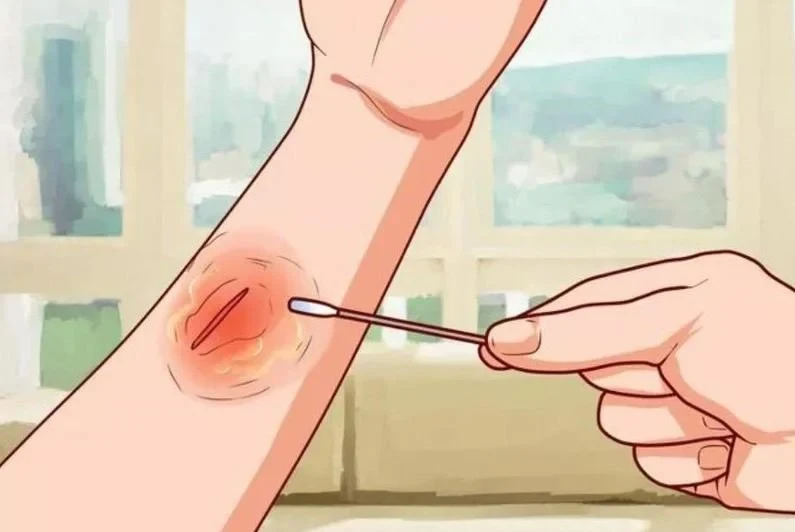 Vết thương hở là gì và cách vệ sinh vết thương hở hằng ngày