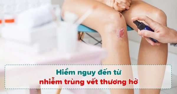 Tầm quan trọng của việc làm lành vết thương hở đúng cách