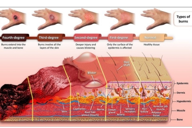 Dấu hiệu nhận biết vết bỏng đang lành & Bí quyết chăm sóc để hạn chế sẹo