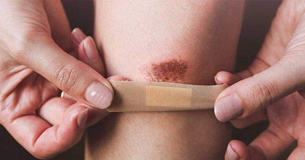 Phòng ngừa nhiễm trùng từ vết thương hở