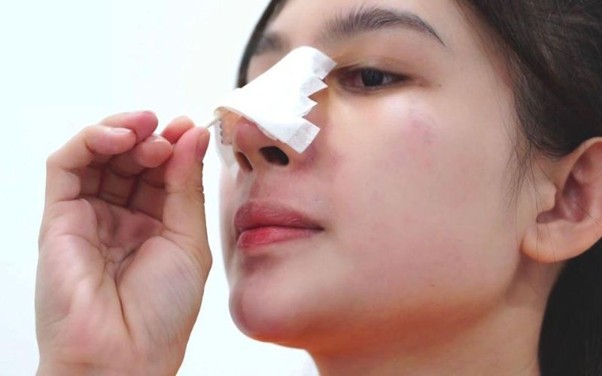 Phục hồi sau nâng mũi: Giảm sưng, ngừa viêm và liền thương nhanh cùng Hema